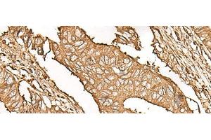 Immunohistochemistry of paraffin-embedded Human colorectal cancer tissue using UBE2A Polyclonal Antibody at dilution of 1:45(x200)