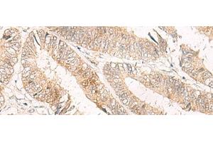 Immunohistochemistry of paraffin-embedded Human colorectal cancer tissue using TRAPPC1 Polyclonal Antibody at dilution of 1:50(x200) (TRAPPC1 Antikörper)