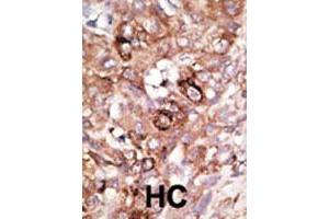 Formalin-fixed and paraffin-embedded human hepatocellular carcinoma tissue reacted with the BAD polyclonal antibody  , which was peroxidase-conjugated to the secondary antibody, followed by AEC staining. (BAD Antikörper  (AA 100-130))
