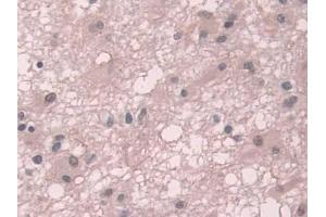 IHC-P analysis of Human Glioma Tissue, with DAB staining. (TKT Antikörper  (AA 1-294))