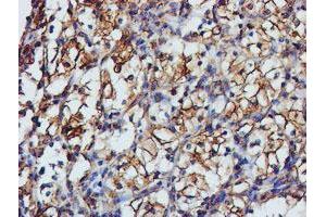 Immunohistochemical staining of paraffin-embedded Carcinoma of Human kidney tissue using anti-TUBAL3 mouse monoclonal antibody. (TUBAL3 Antikörper  (AA 150-446))