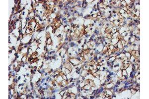Immunohistochemical staining of paraffin-embedded Carcinoma of Human kidney tissue using anti-TUBAL3 mouse monoclonal antibody.