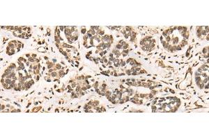Immunohistochemistry of paraffin-embedded Human esophagus cancer tissue using BRD7 Polyclonal Antibody at dilution of 1:50(x200) (BRD7 Antikörper)