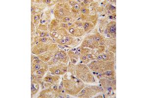 Formalin-fixed and paraffin-embedded human hepatocarcinoma tissue reacted with ALDH1A1 antibody , which was peroxidase-conjugated to the secondary antibody, followed by DAB staining. (ALDH1A1 Antikörper  (AA 302-331))