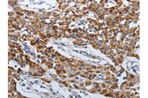 The image on the left is immunohistochemistry of paraffin-embedded Human lung cancer tissue using ABIN7192612(SPAG1 Antibody) at dilution 1/25, on the right is treated with synthetic peptide. (SPAG1 Antikörper)