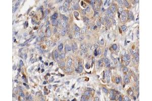 ABIN6266778 at 1/100 staining human ovarian cancer tissue sections by IHC-P. (Fibrillin 1 Antikörper  (C-Term))