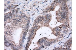 Immunohistochemical staining of paraffin-embedded Adenocarcinoma of Human ovary tissue using anti-BSG mouse monoclonal antibody. (CD147 Antikörper)