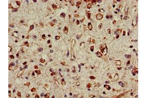 IHC image of ABIN7142234 diluted at 1:500 and staining in paraffin-embedded human glioma performed on a Leica BondTM system. (PSMC4 Antikörper  (Regulatory Subunit 6B))