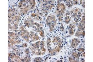 Immunohistochemical staining of paraffin-embedded Carcinoma of liver tissue using anti-PLEK mouse monoclonal antibody. (Pleckstrin Antikörper)