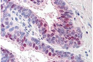 Human Prostate (formalin-fixed, paraffin-embedded) stained with TARBP1 antibody ABIN214523 at 5 ug/ml followed by biotinylated goat anti-rabbit IgG secondary antibody ABIN481713, alkaline phosphatase-streptavidin and chromogen. (TARBP1 Antikörper  (Internal Region))