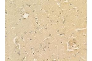 ABIN6262417 and ABIN6277679 at 1/100 staining human glioblastoma by IHC-P. (Serotonin Receptor 3A Antikörper  (Internal Region))