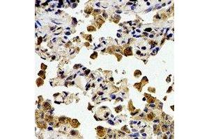 Immunohistochemical analysis of Cystatin A staining in human lung cancer formalin fixed paraffin embedded tissue section. (CSTA Antikörper)