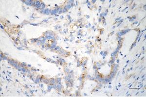 Immunohistochemistry was performed on paraffin-embedded human sigmoid colon carcinoma using interferon induced transmembrane protein 3 antibody (ABIN7799091), 1:200).