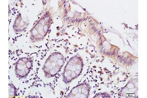 Formalin-fixed and paraffin embedded human colon carcinoma labeled with Anti-LSP1 Polyclonal Antibody, Unconjugated (ABIN755632) at 1:200 followed by conjugation to the secondary antibody and DAB staining