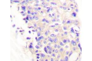 Immunohistochemistry analyzes of PLC γ1 antibody in paraffin-embedded human breast carcinoma tissue. (Phospholipase C gamma 1 Antikörper)