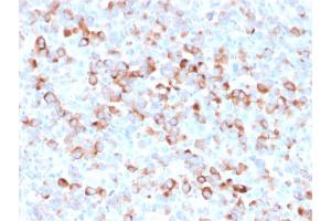 Formalin-fixed, paraffin-embedded Melanoma stained with Tyrosinase Mouse Recombinant Monoclonal Antibody (rOCA1/812). (Rekombinanter TYR Antikörper)