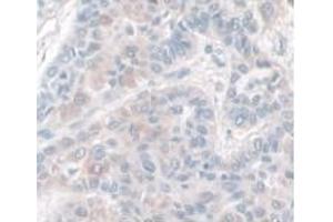IHC-P analysis of Human Liver Cancer Tissue, with DAB staining. (HPR Antikörper  (AA 70-332))