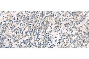 Immunohistochemistry of paraffin-embedded Human tonsil tissue using SERPINB4 Polyclonal Antibody at dilution of 1:40(x200)