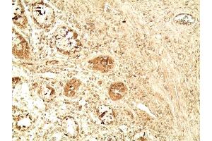 Immunohistochemistry analysis of human colon tumor tissue using Glucagon like peptide 1 pAb,  at a dilution of 1:500. (GLP-1 Antikörper  (AA 1-19))