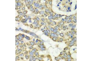Immunohistochemistry of paraffin-embedded human esophageal cancer using TUFM antibody at dilution of 1:100 (x40 lens).