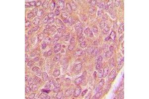 Immunohistochemical analysis of AKAP1 staining in human breast cancer formalin fixed paraffin embedded tissue section. (AKAP1 Antikörper)