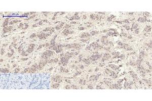 Immunohistochemistry of paraffin-embedded Human liver cancer tissue using MMP2 Polyclonal Antibody at dilution of 1:200. (MMP2 Antikörper)