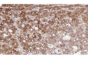 ABIN6279843 at 1/100 staining Human liver cancer tissue by IHC-P. (SLC8A1 Antikörper  (Internal Region))