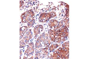 Immunohistochemistry of paraffin-embedded Human liver cancer using LYPL Rabbit pAb (ABIN1680728, ABIN3018907, ABIN3018908 and ABIN6220622) at dilution of 1:100 (40x lens). (LYPLA1 Antikörper  (AA 1-230))