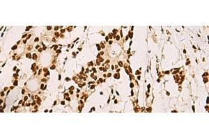 Immunohistochemistry of paraffin-embedded Human colorectal cancer tissue using ELF5 Polyclonal Antibody at dilution of 1:70(x200)