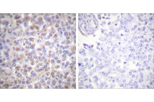 Peptide - +Immunohistochemical analysis of paraffin-embedded human breast carcinoma tissue using 14-3-3 ζ (Ab-58) antibody (#B0001). (14-3-3 zeta Antikörper  (Ser58))