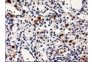 Immunohistochemical staining of paraffin-embedded Carcinoma of Human kidney tissue using anti-PRPSAP2 mouse monoclonal antibody. (PRPSAP2 Antikörper)