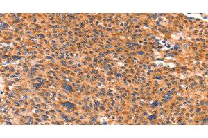 Immunohistochemistry of paraffin-embedded Human liver cancer using AMPD1 Polyclonal Antibody at dilution of 1:80 (AMPD1 Antikörper)