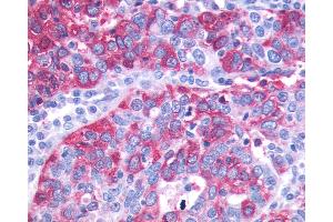 Anti-GPR143 antibody IHC of human Ovary, Carcinoma.