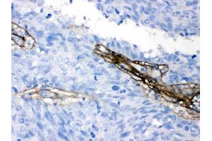 Collagen I was detected in paraffin-embedded sections of human lung cancer tissues using rabbit anti- Collagen I Antigen Affinity purified polyclonal antibody (Catalog # ) at 1 µg/mL. (COL1A1 Antikörper  (C-Term))