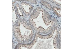 Immunohistochemical staining (Formalin-fixed paraffin-embedded sections) of human prostate cancer with OCLN monoclonal antibody, clone CL1555  shows membranous positivity in tumor cells. (Occludin Antikörper  (AA 282-415))