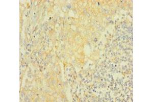Immunohistochemistry of paraffin-embedded human lung cancer using ABIN7167028 at dilution of 1:100 (AKT2 Antikörper  (AA 2-481))