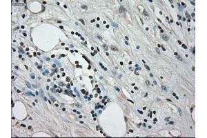 Immunohistochemical staining of paraffin-embedded Adenocarcinoma of colon tissue using anti-CRYABmouse monoclonal antibody. (CRYAB Antikörper)