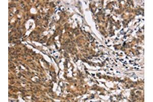 The image on the left is immunohistochemistry of paraffin-embedded Human gastic cancer tissue using ABIN7190329(COL7A1 Antibody) at dilution 1/25, on the right is treated with synthetic peptide. (COL7A1 Antikörper)