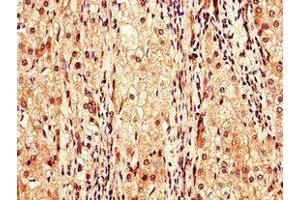 Immunohistochemistry of paraffin-embedded human liver cancer using ABIN7147989 at dilution of 1:100 (Coagulation Factor IX Antikörper  (AA 144-239))