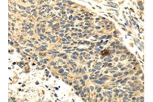 The image on the left is immunohistochemistry of paraffin-embedded Human esophagus cancer tissue using ABIN7131002(SEMA4F Antibody) at dilution 1/35, on the right is treated with fusion protein. (SEMA4F Antikörper)