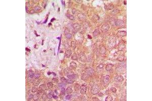 Immunohistochemical analysis of NAV1 staining in human breast cancer formalin fixed paraffin embedded tissue section.