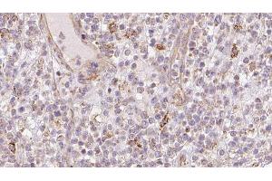 ABIN6273211 at 1/100 staining Human lymph cancer tissue by IHC-P. (CNPY2/MSAP Antikörper  (C-Term))