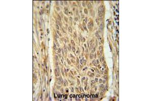 INMT Antibody immunohistochemistry analysis in formalin fixed and paraffin embedded human lung carcinoma followed by peroxidase conjugation of the secondary antibody and DAB staining.