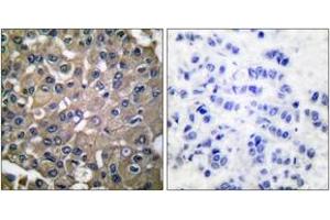 Immunohistochemistry analysis of paraffin-embedded human breast carcinoma tissue, using MMP-9 Antibody. (MMP 9 Antikörper  (AA 651-700))