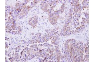 IHC-P Image SGTA antibody detects SGTA protein at cytosol on human lung adenocarcinoma by immunohistochemical analysis.