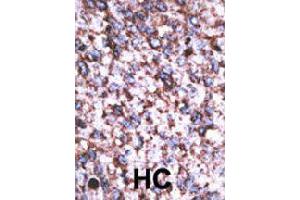 Formalin-fixed and paraffin-embedded human hepatocellular carcinoma tissue reacted with BACE2 polyclonal antibody  , which was peroxidase-conjugated to the secondary antibody, followed by AEC staining.