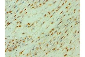 Immunohistochemistry of paraffin-embedded human breast cancer using ABIN7147792 at dilution of 1:100 (CLOCK Antikörper  (AA 577-846))
