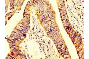 IHC image of ABIN7160496 diluted at 1:200 and staining in paraffin-embedded human colon cancer performed on a Leica BondTM system. (MYOC Antikörper  (AA 183-294))