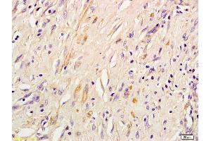 Formalin-fixed and paraffin embedded human lung inflammation labeled with Rabbit Anti IRS-3 Polyclonal Antibody, Unconjugated (ABIN726005) at 1:200 followed by conjugation to the secondary antibody and DAB staining (IRS3 Antikörper  (AA 261-360))