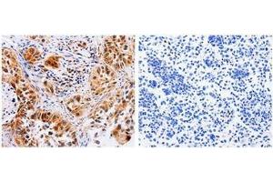 The image on the left is immunohistochemistry of paraffin-embedded Human lung cancer tissue using 31024 (AAK1 Antibody) at dilution 1/30, on the right is treated with the fusion protein. (AAK1 Antikörper  (N-Term))